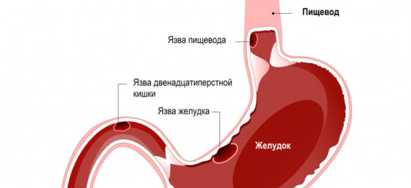 Гастродуоденит: причины, симптомы, лечение
