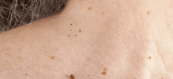 Как удалить папиллому на ножке?