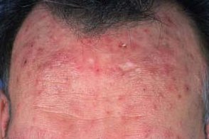 Эозинофильный фолликулит: что это такое и как лечить?