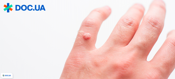 Как безболезненно убрать куриную бородавку на пальце руки