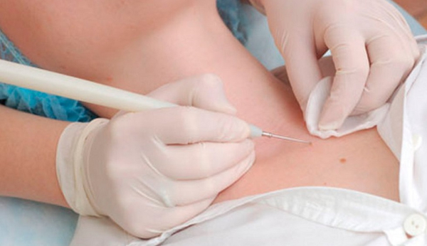 Как избавиться от висячих папиллом?