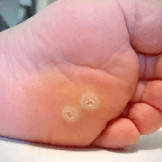 Как отличить стержневую мозоль от подошвенной бородавки