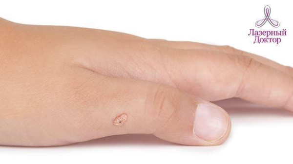 Как избавиться от бородавок на кисти руки