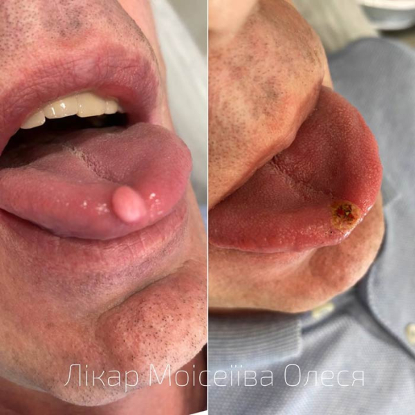 Уход за кожей после удаления папилломы лазером