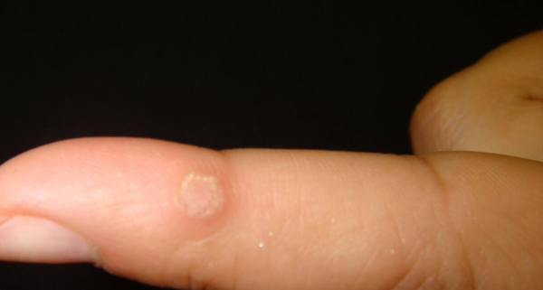 Передаются ли бородавки через рукопожатие