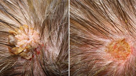 Удаление папиллом на голове в волосах