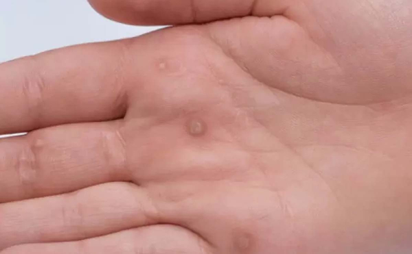 Причины, симптомы и лечение бородавок на ладони