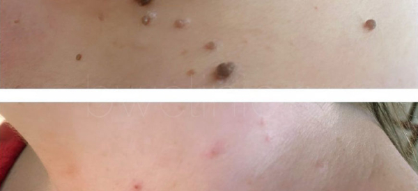 Можно ли в баню после удаления папиллом?