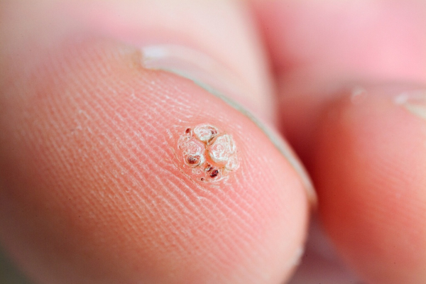 Бородавка на ножке: причины и лечение