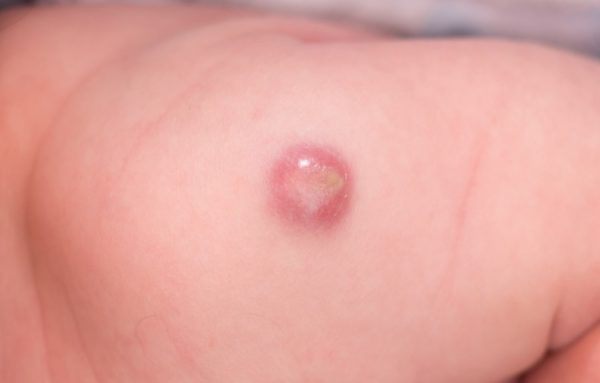 Как избавиться от оставшейся шишки после фурункула?