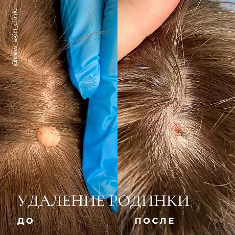 Удаление папиллом на голове в волосах