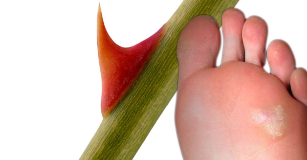 Лечение бородавок на ногах народными средствами