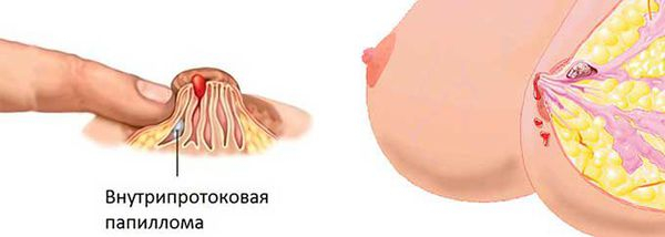 Бородавки на сосках при беременности: причины и лечение