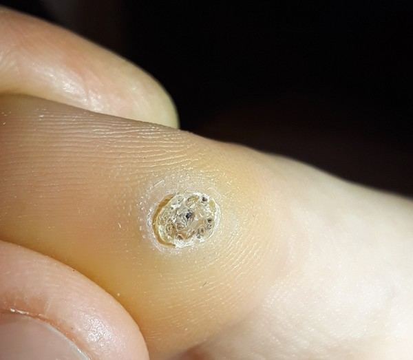 Красная бородавка на коже: что делать?