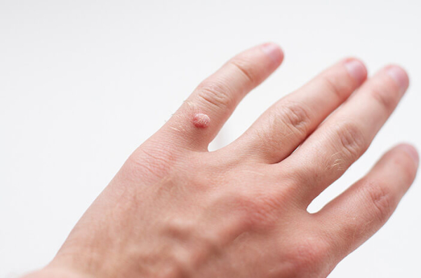 Плоские бородавки: причины, симптомы и лечение