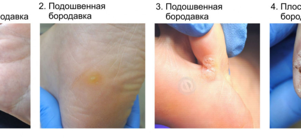 Как отличить бородавку от прыща?