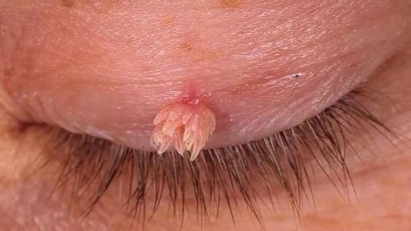 Какие виды бородавок на лице существуют?