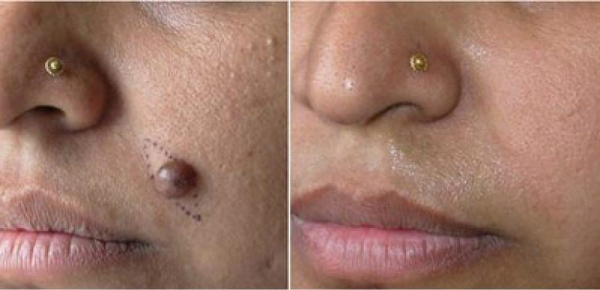 Удаление папиллом радиоволновым методом или лазером &mdash; что лучше