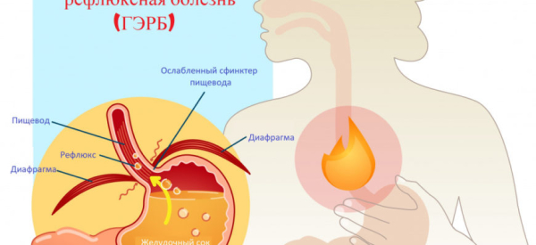 Диспепсия: причины, симптомы и методы лечения