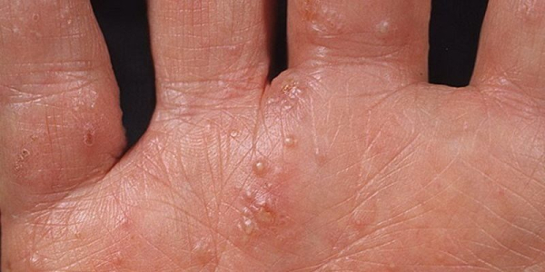 Бородавки между пальцев руки: причины, симптомы, лечение