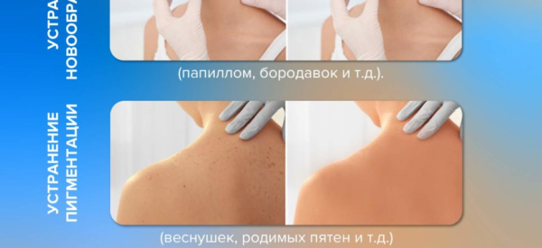 Лечение бородавок йодом: особенности, правила применения и отзывы