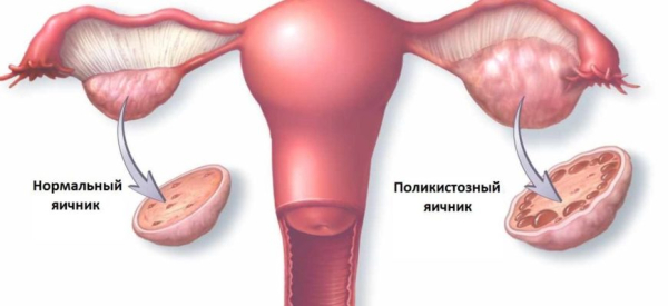 Оофорит или воспаление яичников: причины, симптомы, лечение