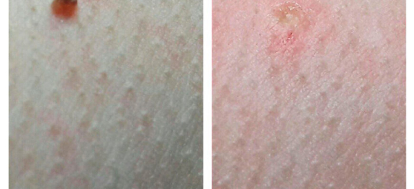 Уход за кожей после удаления папилломы лазером