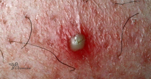 Причины и лечение фолликулита после бритья