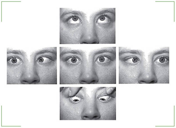 Нистагм или тремор глаз: причины, симптомы, лечение