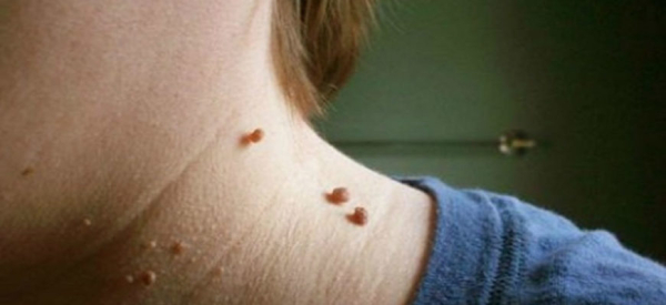 Почему появляются папилломы на шее у женщин и как их лечить?