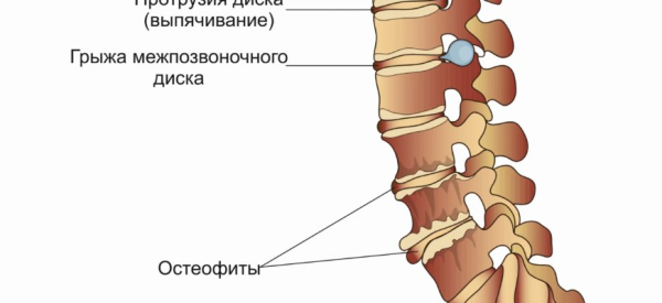 Остеофиты: причины, симптомы, лечение и профилактика