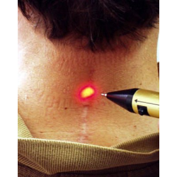 Удаление папиллом лазером: последствия и отзывы