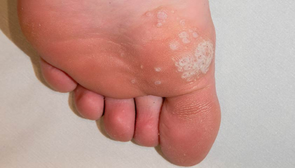 Что делать, если опухла бородавка