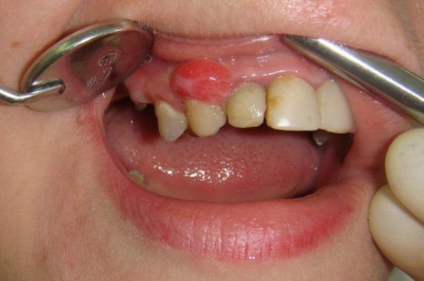 К какому врачу обращаться при папилломах во рту?