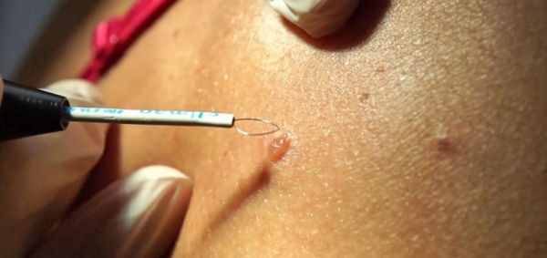 Уход за раной после удаления папилломы радиоволновым методом