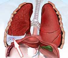 Плеврит легких: виды, причины, диагностика и лечение