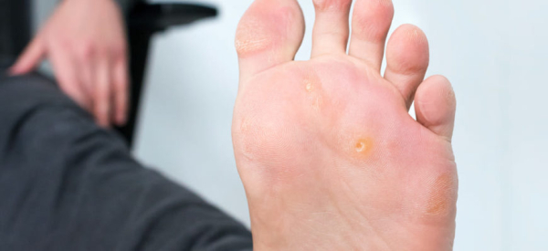 Бородавка на ножке: причины и лечение