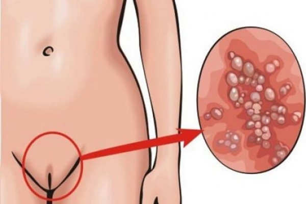 Бородавки на интимных местах у женщин: симптомы и лечение