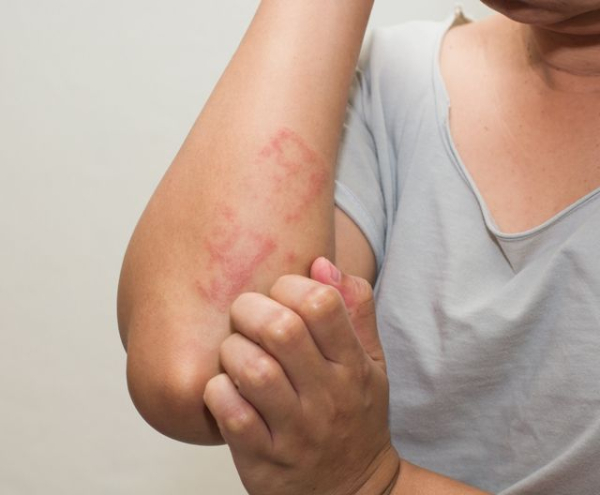 Удаление бородавок луком: рецепты приготовления