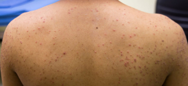 Эозинофильный фолликулит: что это такое и как лечить?