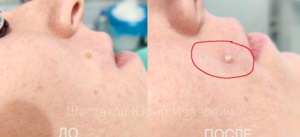 Как избавиться от бородавок на губе