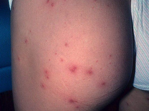 Псевдомонадный фолликулит: симптомы и лечение