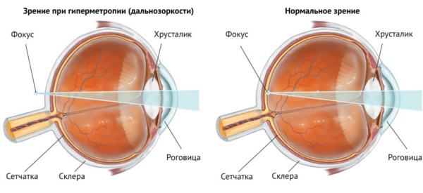 Гиперметропия у взрослых: причины и лечение дальнозоркости