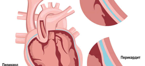 Перикардит сердца: причины, симптомы, лечение