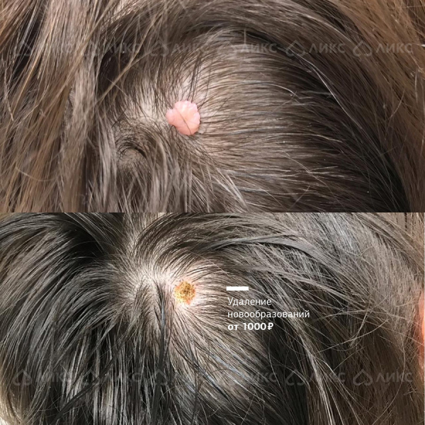 Удаление папиллом на голове в волосах