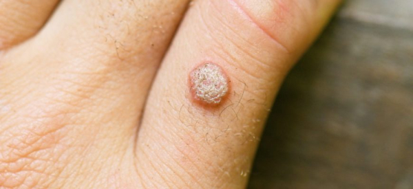 Почему бородавки растут и что с этим делать