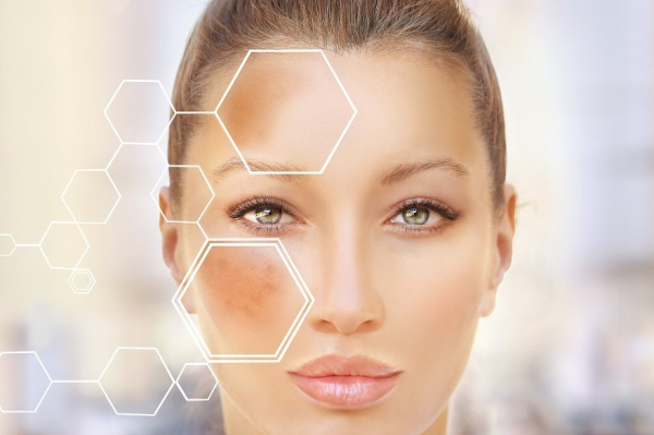 Мелазма: причины, симптомы, лечение, профилактика