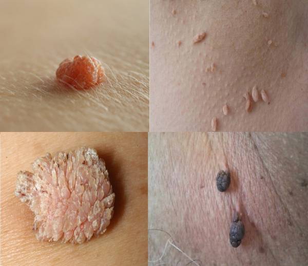 Лазерное удаление папиллом