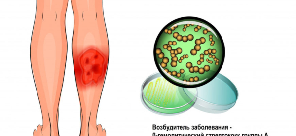 Рожа: причины, симптомы, лечение и осложнения