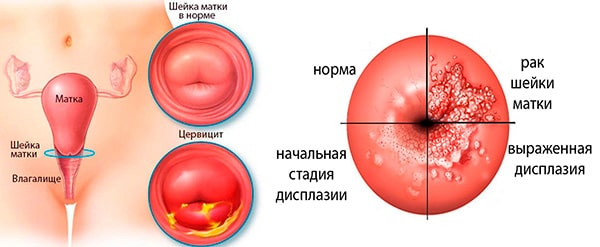Папилломы во влагалище: симптомы и лечение